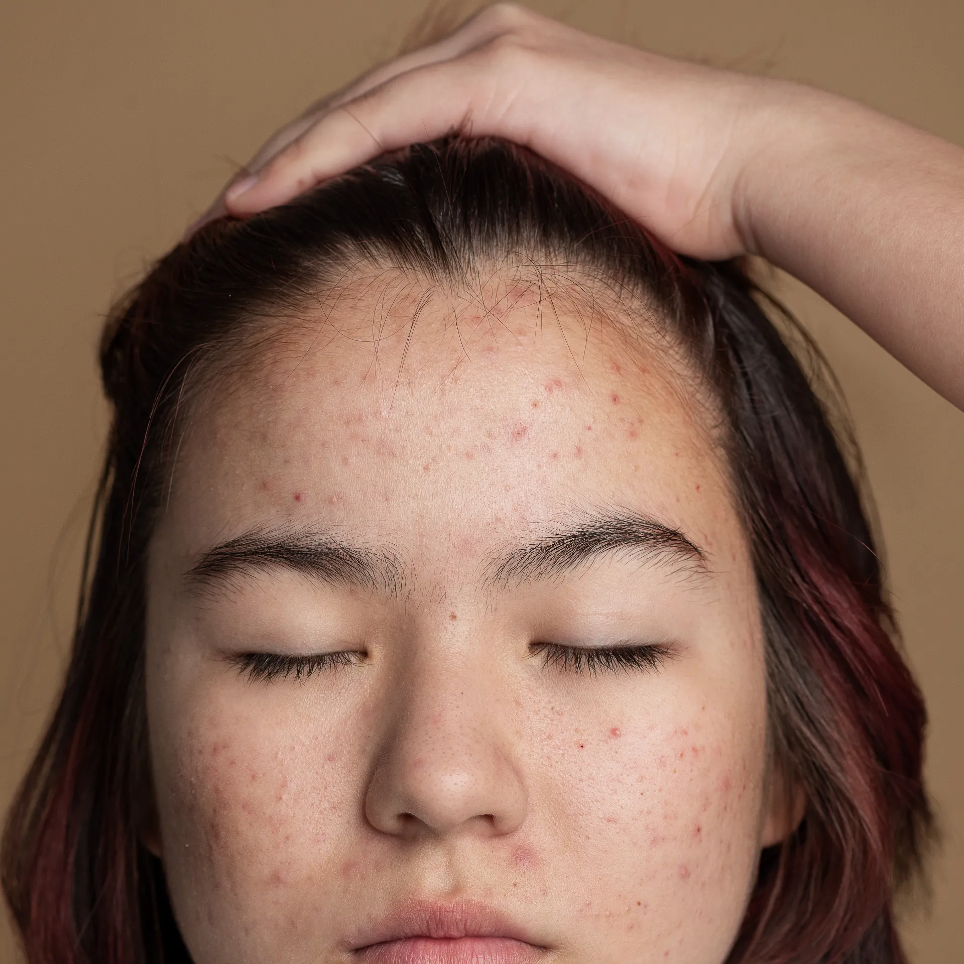 Understanding Melasma: Triggers & Treatments (Updated)